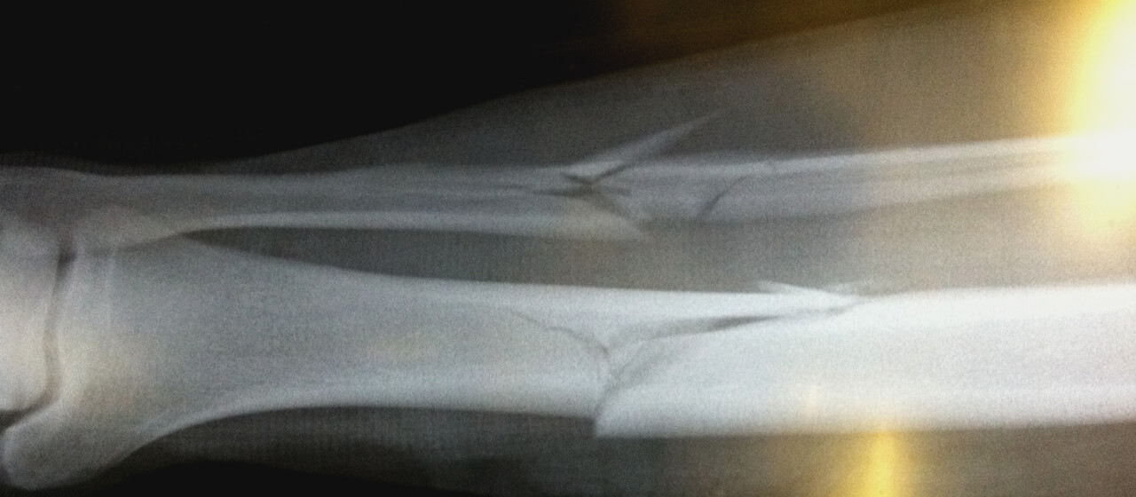 James Rosatos Tibia Fibula Compound fracture