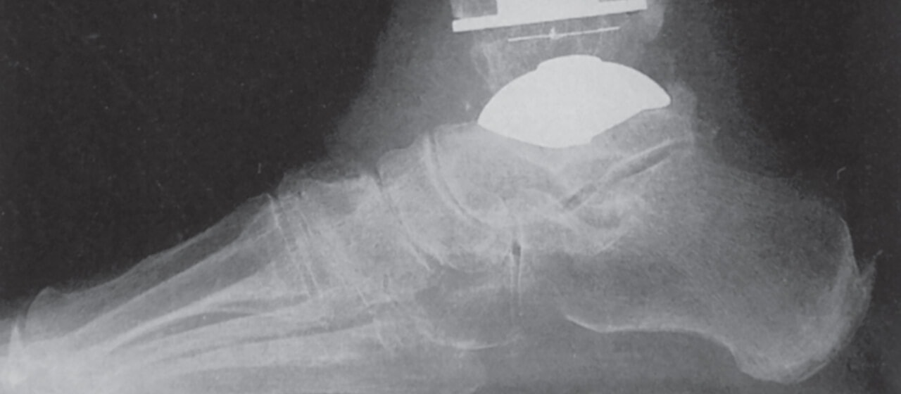 Braxton Smith's diagonal split fibula