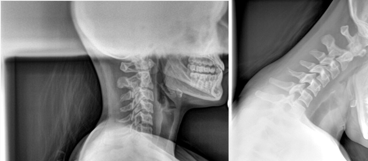 neck hyperflexion injury in rugby