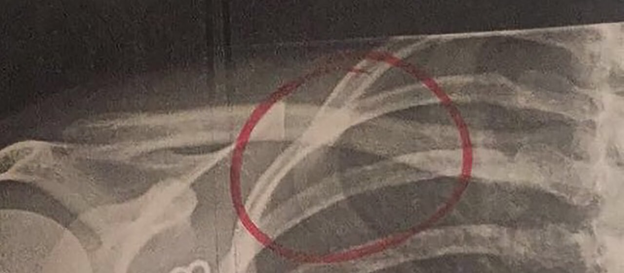 meghan hogan's broken collarbone